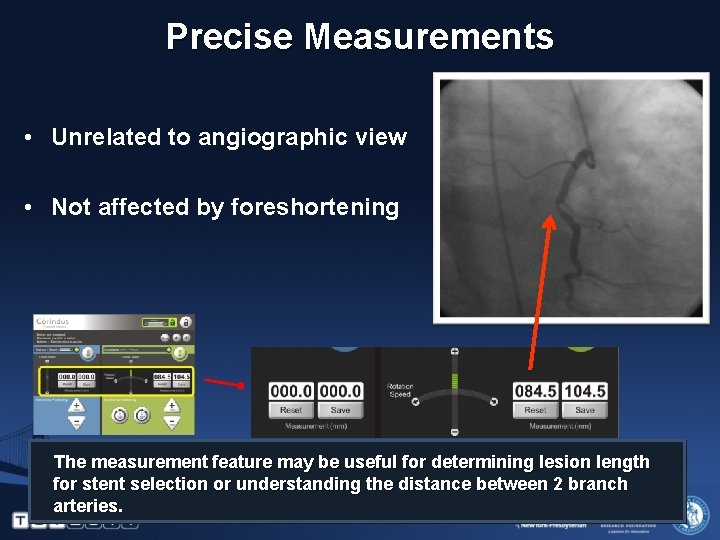 Precise Measurements • Unrelated to angiographic view • Not affected by foreshortening The measurement