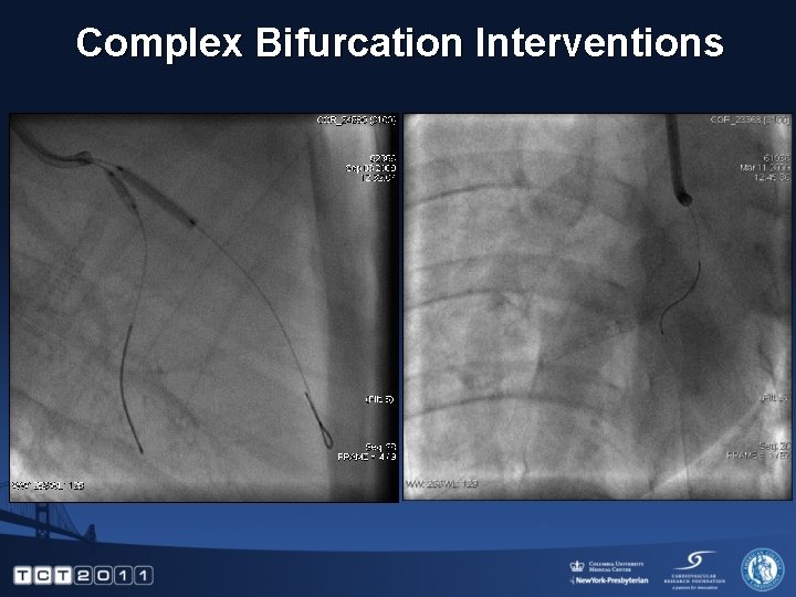 Complex Bifurcation Interventions 