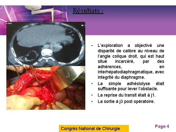 Résultats : • • L’exploration a objectivé une disparité de calibre au niveau de