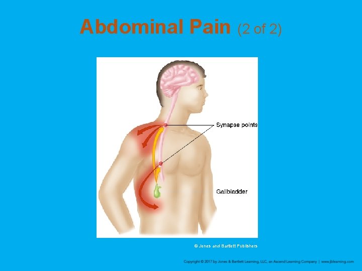 Abdominal Pain (2 of 2) © Jones and Bartlett Publishers 