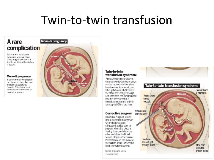 Twin-to-twin transfusion 