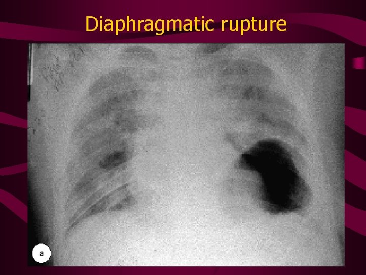 Diaphragmatic rupture 