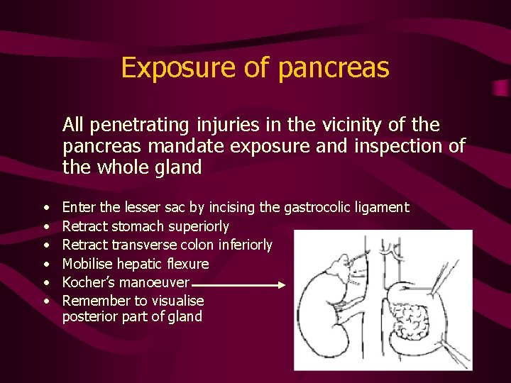 Exposure of pancreas All penetrating injuries in the vicinity of the pancreas mandate exposure