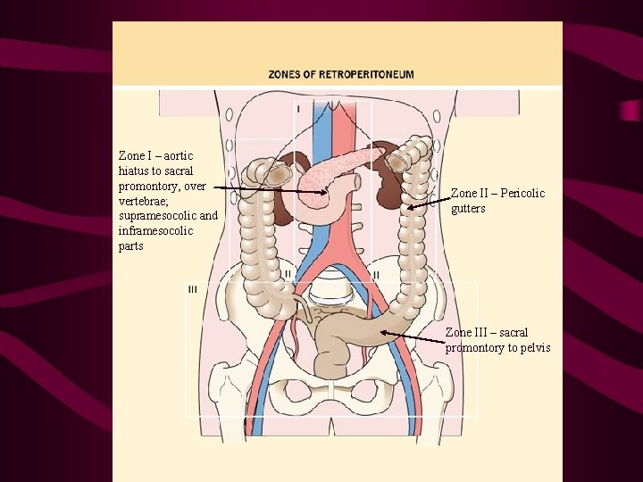 Zone I – aortic hiatus to sacral promontory, over vertebrae; supramesocolic and inframesocolic parts