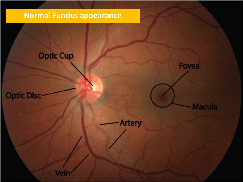 Normal Fundus appearance 
