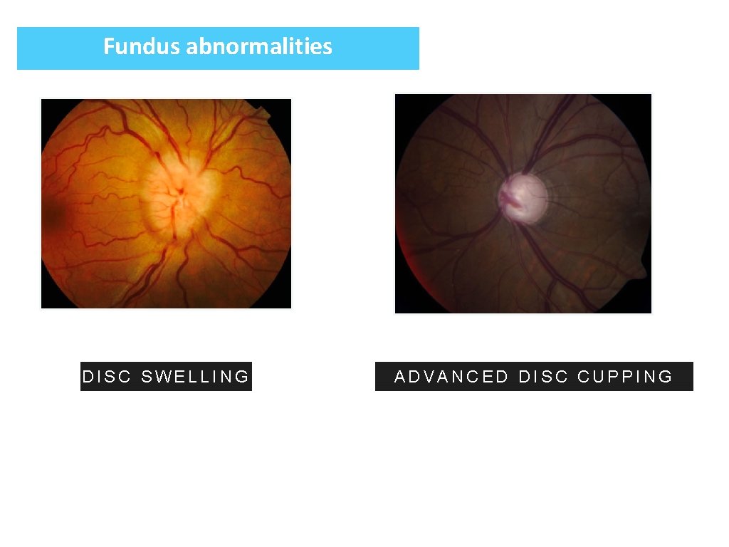 Fundus abnormalities DISC SWELLING ADVANCED DISC CUPPING 