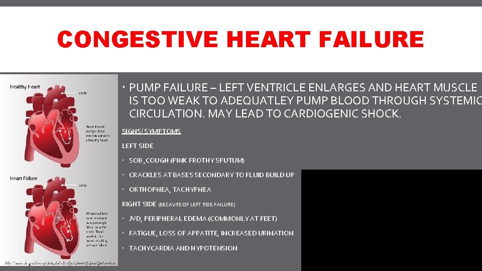 CONGESTIVE HEART FAILURE PUMP FAILURE – LEFT VENTRICLE ENLARGES AND HEART MUSCLE IS TOO