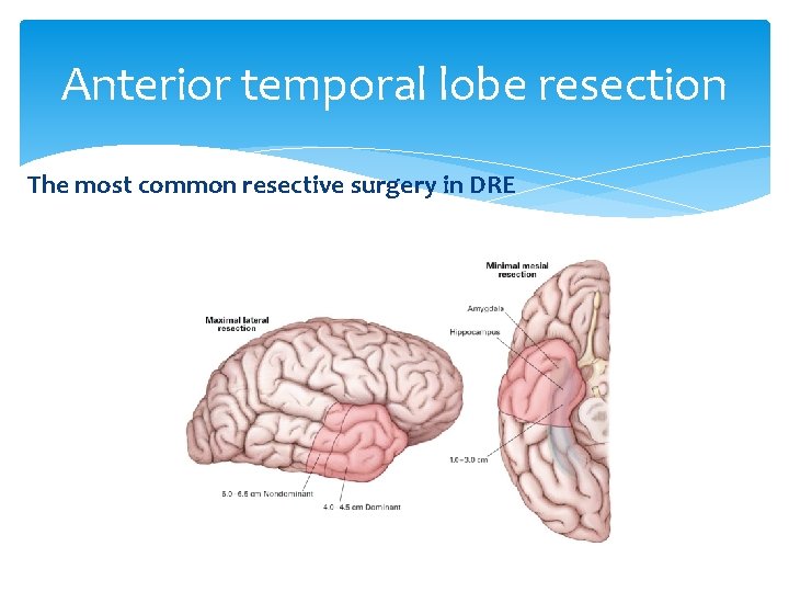 Anterior temporal lobe resection The most common resective surgery in DRE 