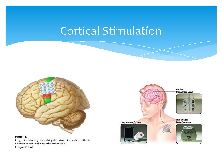 Cortical Stimulation 