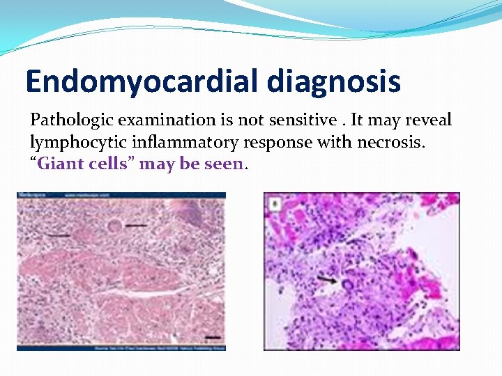 Endomyocardial diagnosis Pathologic examination is not sensitive. It may reveal lymphocytic inflammatory response with