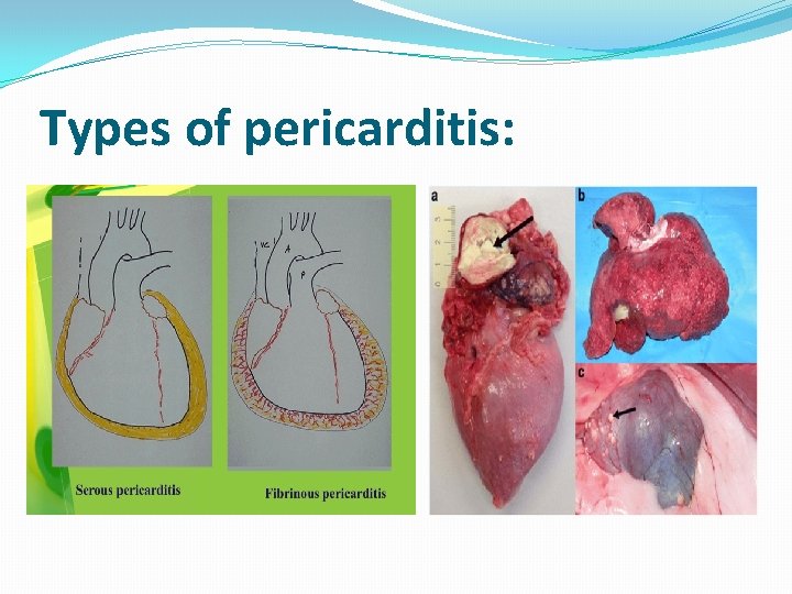 Types of pericarditis: 