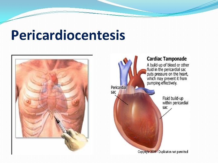 Pericardiocentesis 