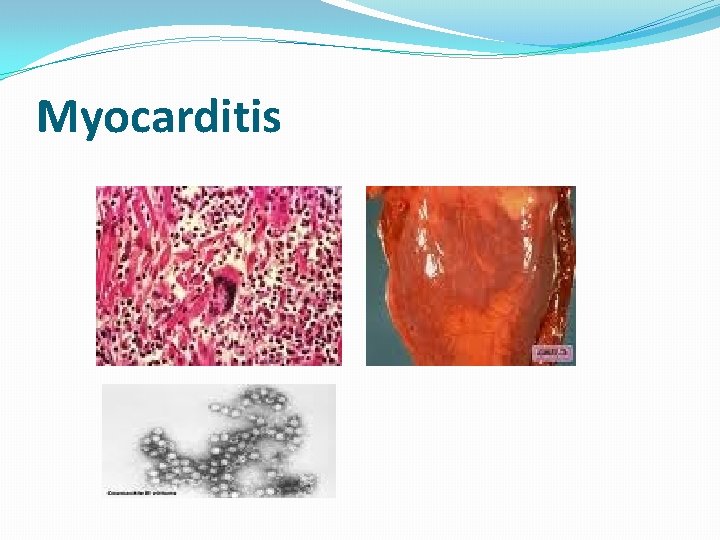Myocarditis 
