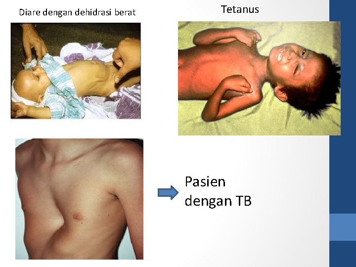 Diare dengan dehidrasi berat Tetanus Pasien dengan TB 