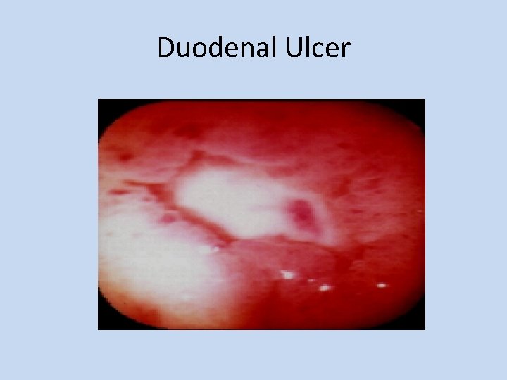 Duodenal Ulcer 