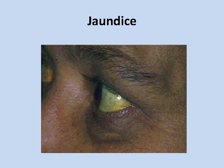 Jaundice 