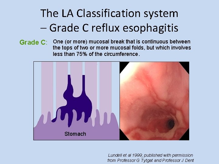 The LA Classification system – Grade C reflux esophagitis Grade C: One (or more)