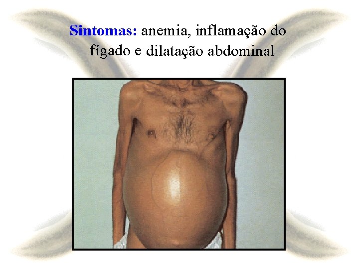 Sintomas: anemia, inflamação do fígado e dilatação abdominal 