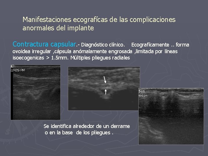 Manifestaciones ecografícas de las complicaciones anormales del implante Contractura capsular. - Diagnóstico clínico. Ecografícamente.