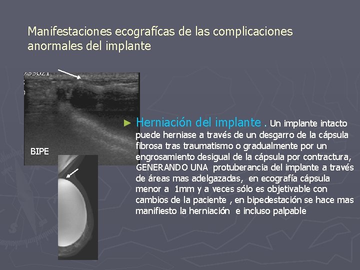 Manifestaciones ecografícas de las complicaciones anormales del implante ► BIPE Herniación del implante. Un