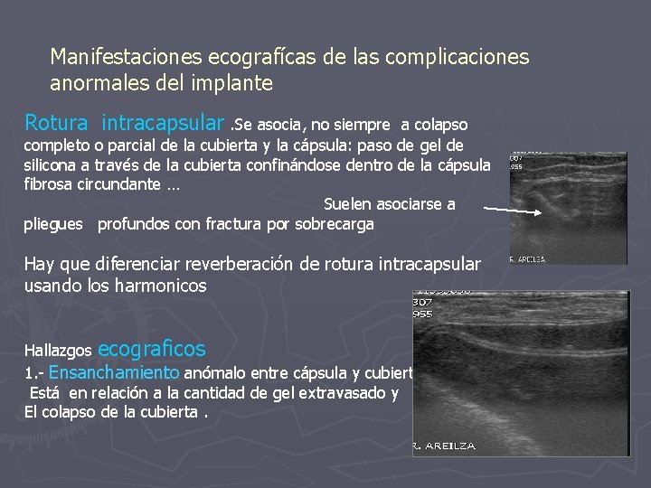 Manifestaciones ecografícas de las complicaciones anormales del implante Rotura intracapsular. Se asocia, no siempre
