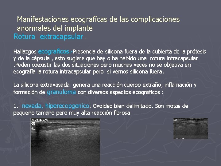 Manifestaciones ecografícas de las complicaciones anormales del implante Rotura extracapsular. Hallazgos ecograficos. -Presencia de