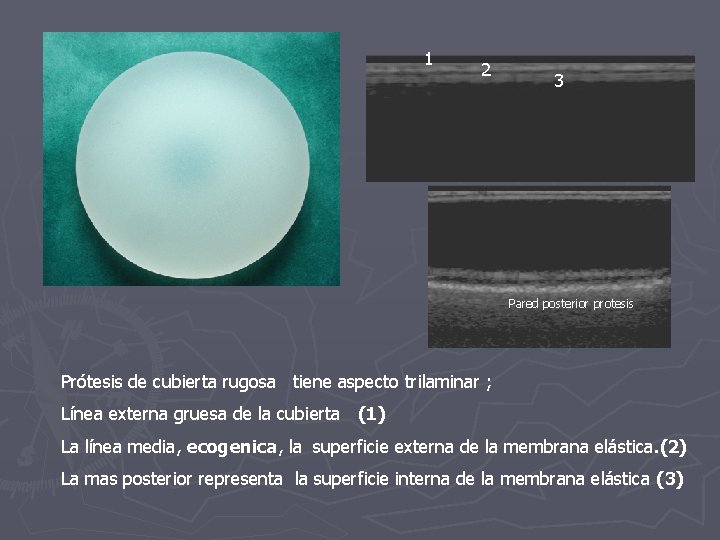 1 2 3 Pared posterior protesis Prótesis de cubierta rugosa tiene aspecto trilaminar ;