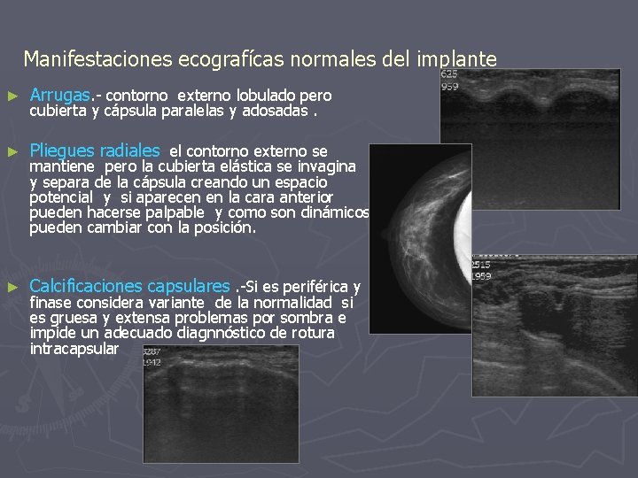 Manifestaciones ecografícas normales del implante ► Arrugas. - contorno externo lobulado pero ► Pliegues