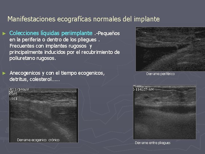 Manifestaciones ecografícas normales del implante ► Colecciones líquidas periimplante. -Pequeños ► Anecogenicos y con