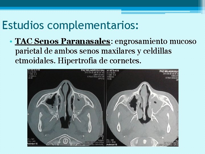 Estudios complementarios: • TAC Senos Paranasales: engrosamiento mucoso parietal de ambos senos maxilares y