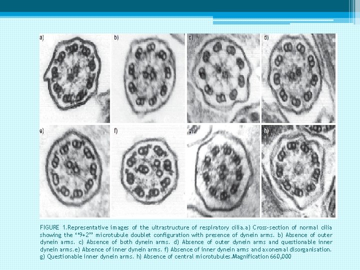 FIGURE 1. Representative images of the ultrastructure of respiratory cilia. a) Cross-section of normal