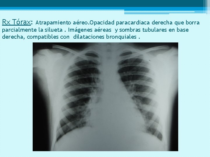 Rx Tórax: Atrapamiento aéreo. Opacidad paracardiaca derecha que borra parcialmente la silueta. Imágenes aéreas