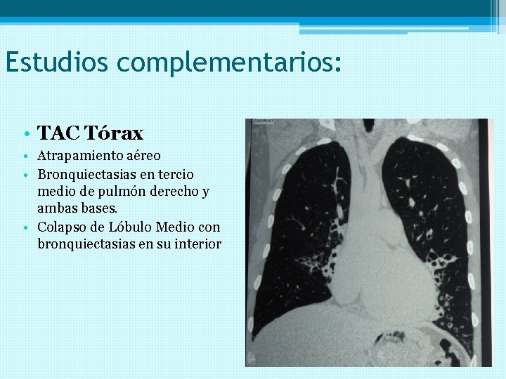 Estudios complementarios: • TAC Tórax • Atrapamiento aéreo • Bronquiectasias en tercio medio de