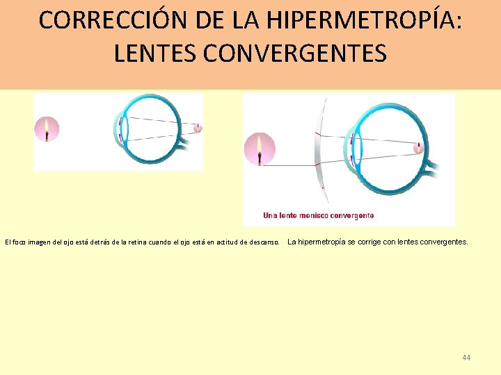 CORRECCIÓN DE LA HIPERMETROPÍA: LENTES CONVERGENTES El foco imagen del ojo está detrás de