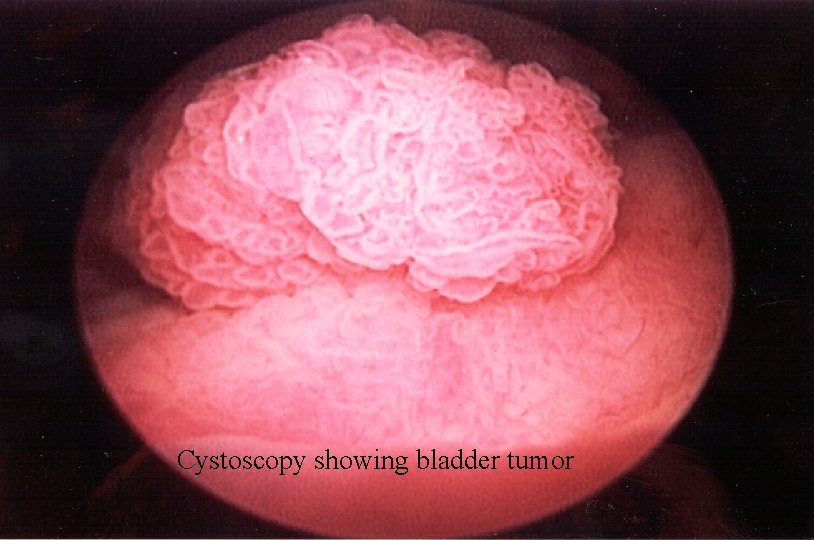 Cystoscopy showing bladder tumor 