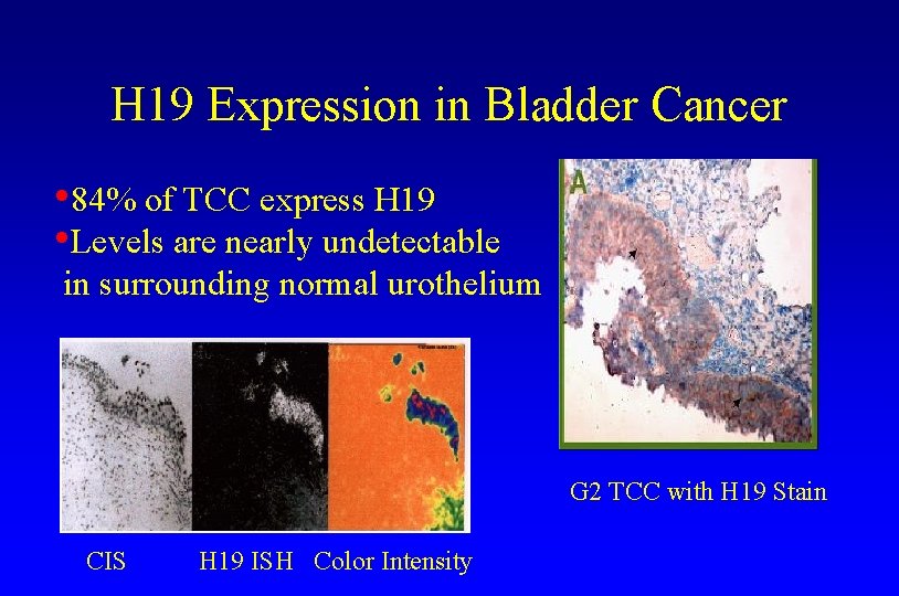 H 19 Expression in Bladder Cancer • 84% of TCC express H 19 •