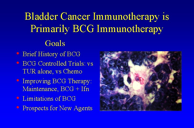 Bladder Cancer Immunotherapy is Primarily BCG Immunotherapy Goals • • • Brief History of