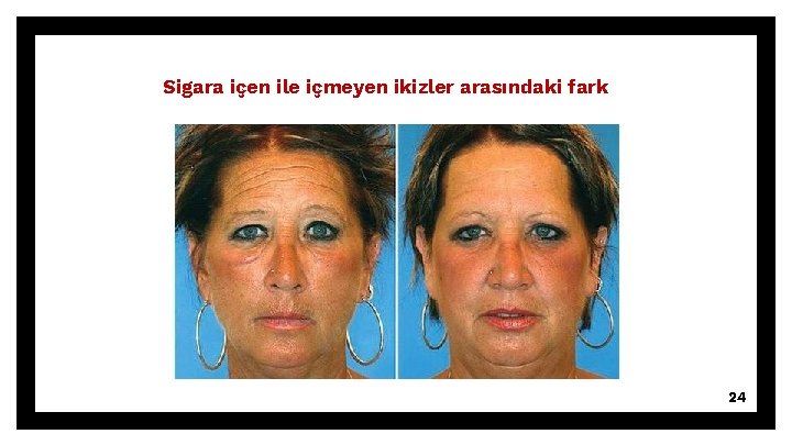 Sigara içen ile içmeyen ikizler arasındaki fark 24 