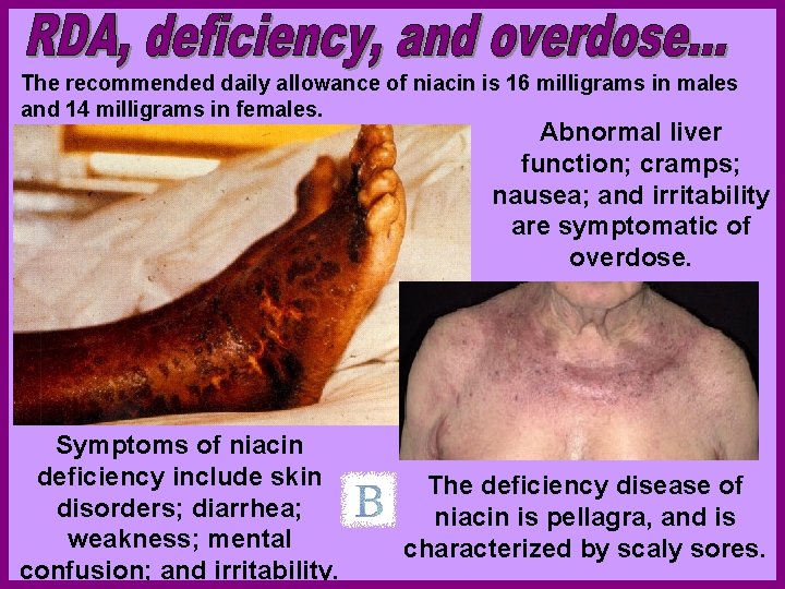 The recommended daily allowance of niacin is 16 milligrams in males and 14 milligrams