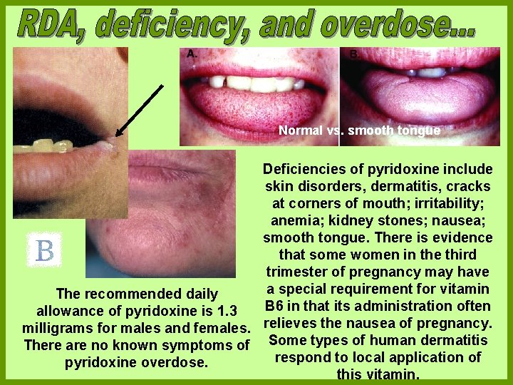 Normal vs. smooth tongue Deficiencies of pyridoxine include skin disorders, dermatitis, cracks at corners