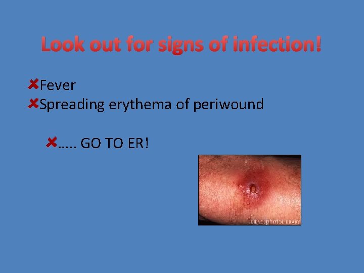 Look out for signs of infection! Fever Spreading erythema of periwound …. . GO