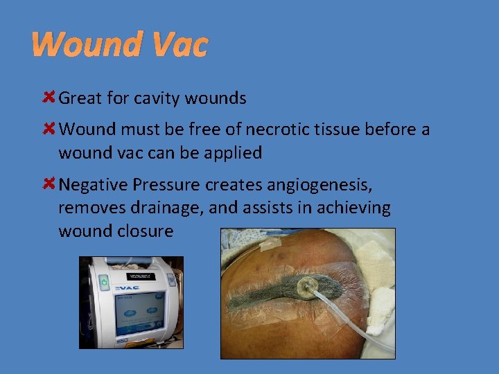 Wound Vac Great for cavity wounds Wound must be free of necrotic tissue before