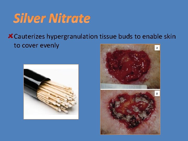 Silver Nitrate Cauterizes hypergranulation tissue buds to enable skin to cover evenly 