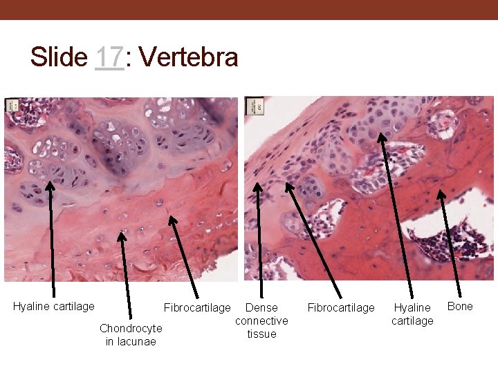 Slide 17: Vertebra Hyaline cartilage Fibrocartilage Chondrocyte in lacunae Dense connective tissue Fibrocartilage Hyaline