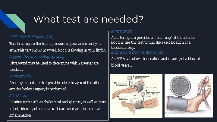 What test are needed? Arteriogram Ankle-Brachial Index (ABI) Test to compare the blood pressure