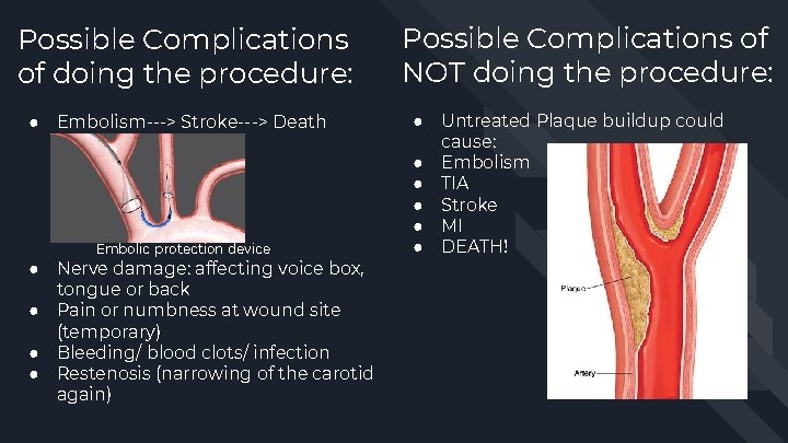 Possible Complications of doing the procedure: ● Embolism---> Stroke---> Death Embolic protection device ●