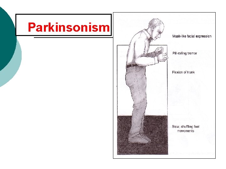 Parkinsonism 