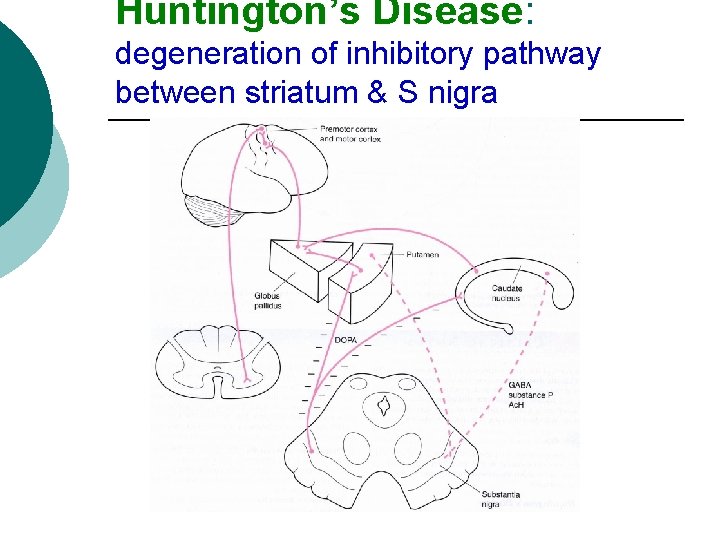 Huntington’s Disease: degeneration of inhibitory pathway between striatum & S nigra 