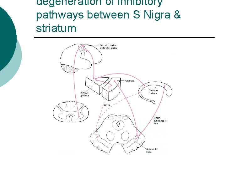 degeneration of inhibitory pathways between S Nigra & striatum 