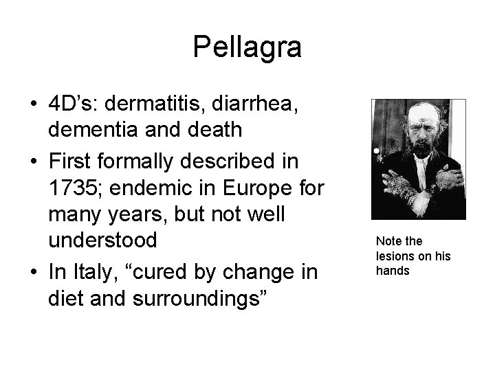 Pellagra • 4 D’s: dermatitis, diarrhea, dementia and death • First formally described in